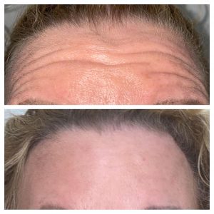 before and after botox aesthetic treatment